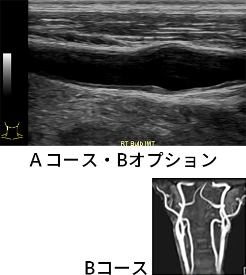 頸部血管の疾患がわかります