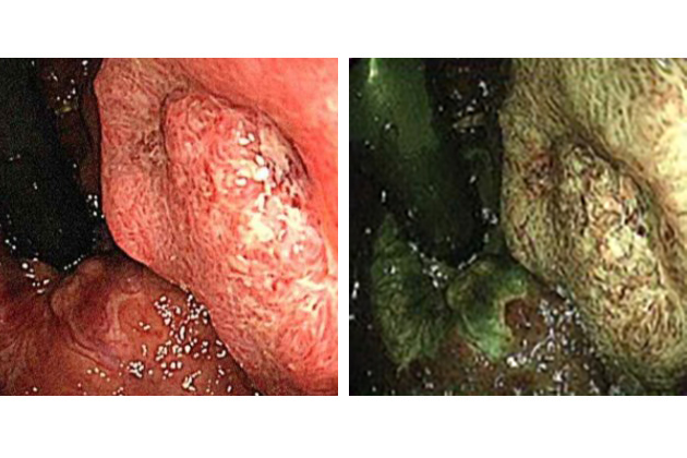 大腸内視鏡検査の様子